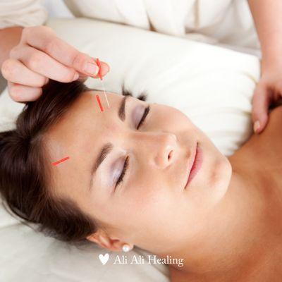 Facial Rejuvenation Acupuncture