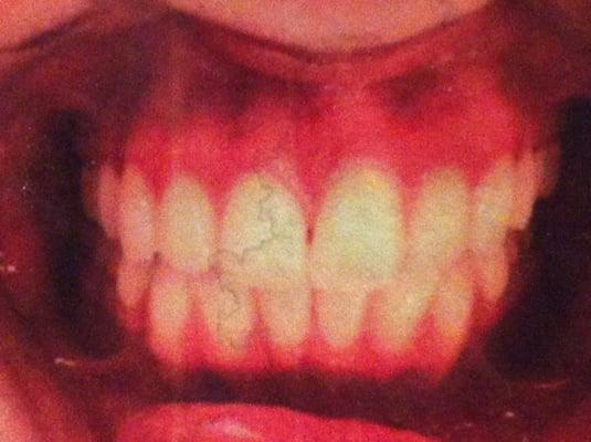 BEFORE: gap between my front two teeth. Ignore the stains, I accidentally spilled water on my copy of the photo.