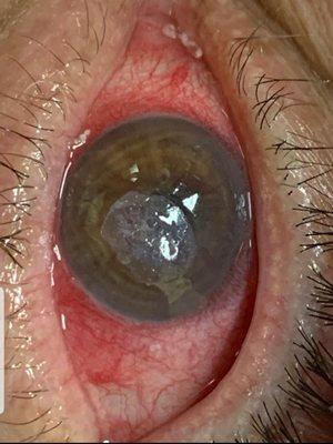 Had  an ulcer due to Sjögren's Syndrome and needed a transplant of the cornea, right eye