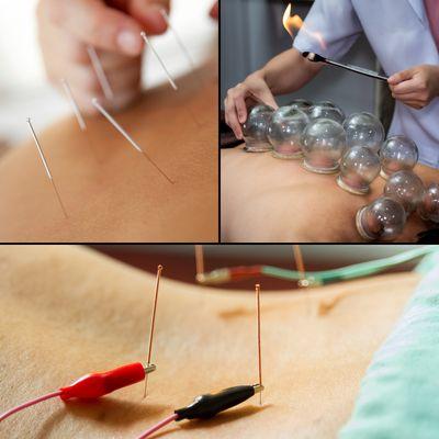 Acupuncture modalities