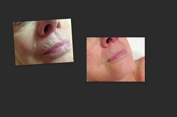 microneedling results - glo permanent cosmetics/anti-aging specialist
 glo facial spa & skin center