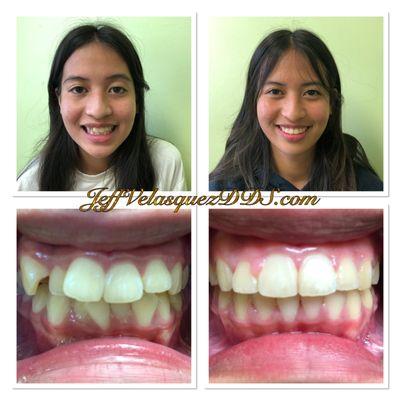 562-424-9473 https://www.jeffvelasquezdds.com/braces--invisalign.html