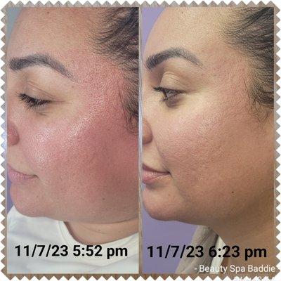 Reduction in redness and inflammation (from ProCell treatment) 30 minutes post application of Epicutis Lipid Serum.