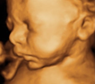 One of our 3D Ultrasound pics