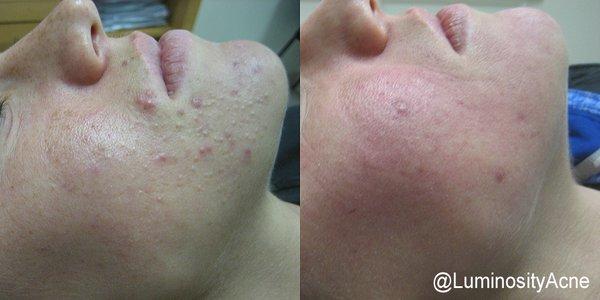 Acne Treatment results at Luminosity Acne Skincare.