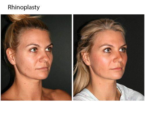 Rhinoplasty