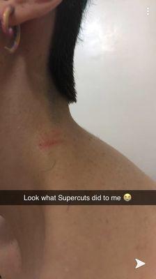 Razor burn from Supercuts