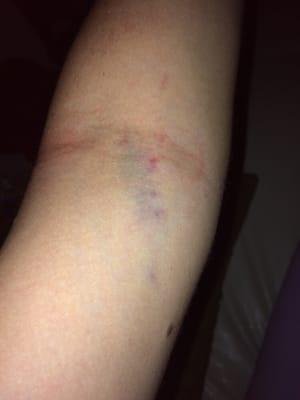 The bruise that formed the night of my visit.