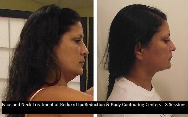 Face / Neck Treatment - Before and After Reduxx