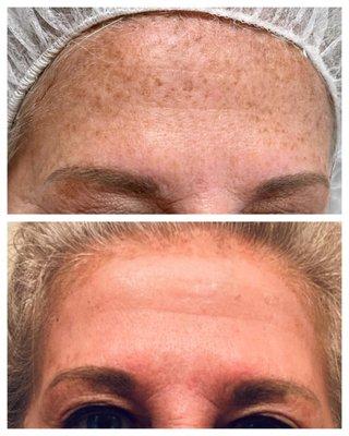 IPL Photo-Facial laser reduces sun damage. Our client had 1 session of IPL.