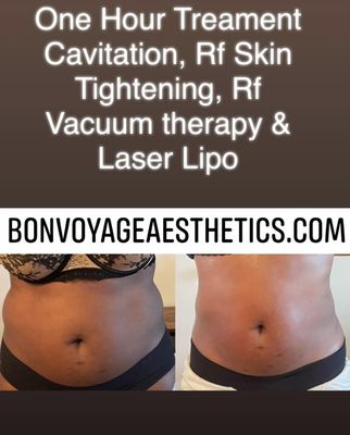 This is what we can do with one treatment. Body contouring works!