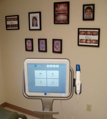 Digital Intra Oral Scanner