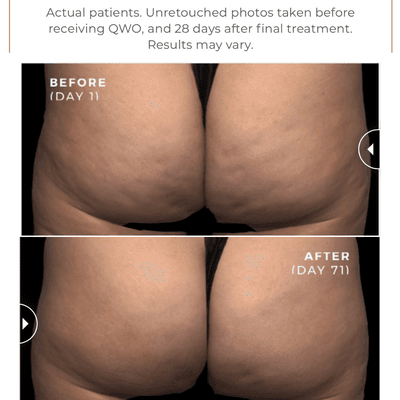 QWO Cellulite reduction - First FDA approved injectable!