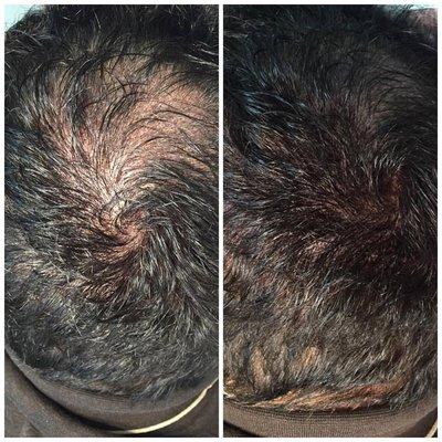 Scalp Micropigmentation