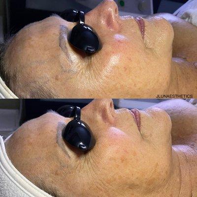 Collagen Lift Facial