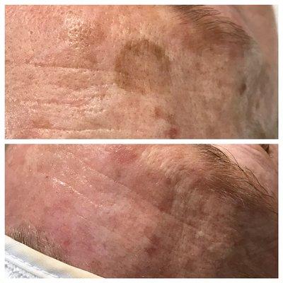 Hyper-Pigmentation reduction using chemical peels