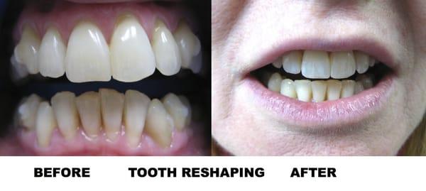 Tooth Reshaping