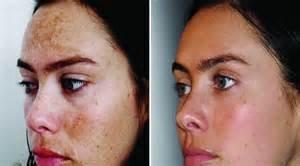 before and after the chemical peel