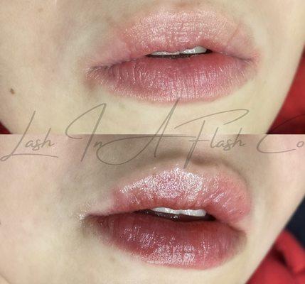 .5 ml lip filler!