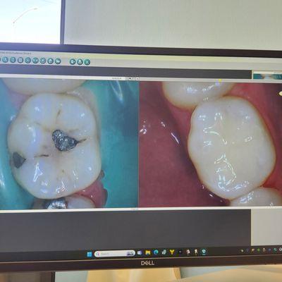 My amalgam fillings had cavities that had gotten larger under the original cavity. They were fixed and look so much better.