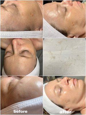 Before and after of a dermaplane facial