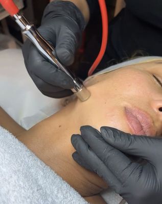 Microdermabrasion Facial