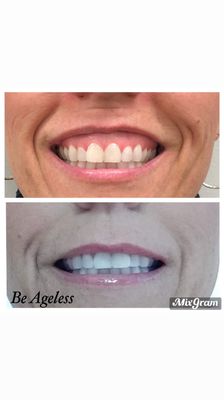 4 days post Xeomin (Botox competitor) to fix that gummy smile!