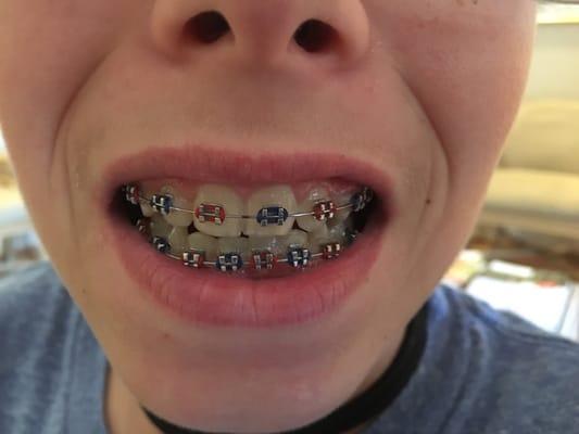 Braces.