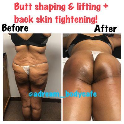 We can enhance and lift your buttocks and shape them into that look you may desire. Contact us today to learn more & book your consultation!