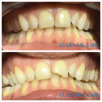 Natural white filling to restore broken tooth.