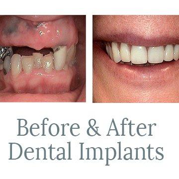 Before & After Dental Implants