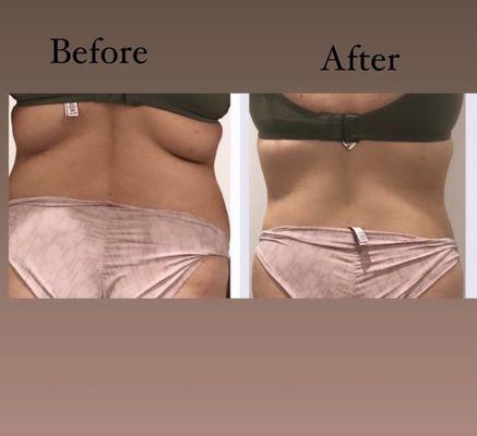 Body sculpting is nonivasive procedure to get rid of extra skin. Eliminate excess fat. Reshape or contour the area.