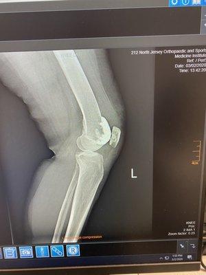 Patella-Femoral Replacement