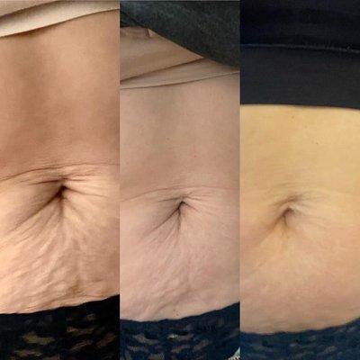 Before and after of Accent Skin Tightening Laser on a abdomen