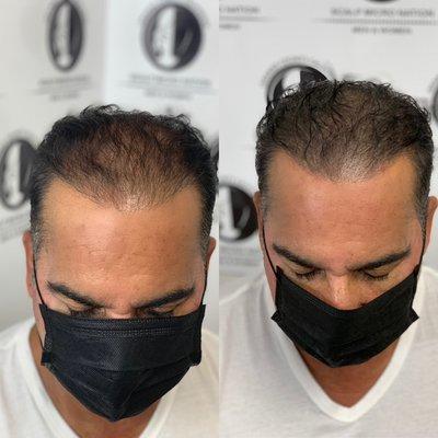 Scalp Micro Filler Treatment