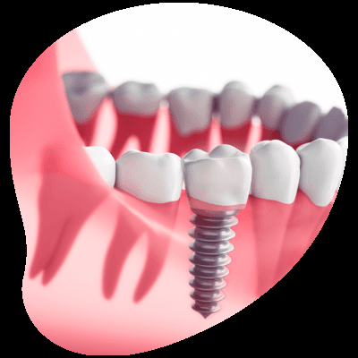 Ouray Dental - General, Implants & Dentures