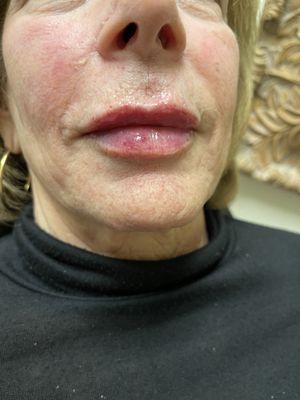 Immediately after lip filler.