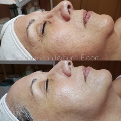 After ONE Clarity Rx Glycolic Peel