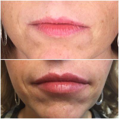 Lips before and after, lip enhancement can be subtle, natural #juvaderm #lipenhancement #naturalresults #subtlelips #lipinjection #lipstick