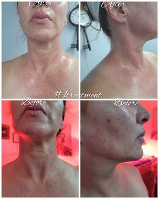 skin tightening