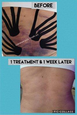 After surgery pain, bruising, and swelling reduced in one treatment. #liposuction #tummy tuck #mommy makeover