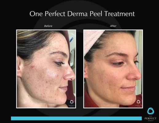 Our Perfect Derma Peels aid in treating acne along with a good home routine.