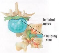 Suffering from a bulging disc?  Chiropractic can help!