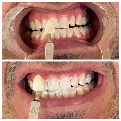 Tooth whitening