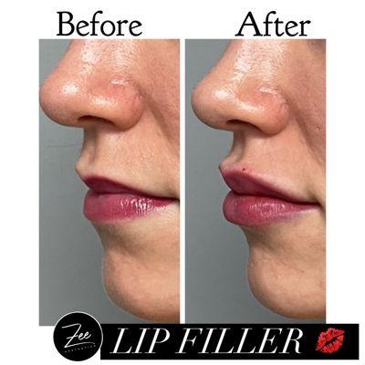 Lips Before/After