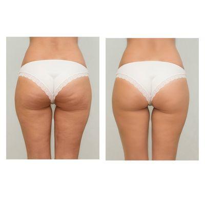 Endermologie Before/After