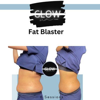 6 Fat Blaster sessions utilizing ultrasonic cavitation and radio frequency.