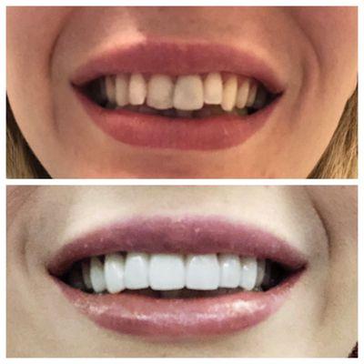 Before and after: 7 Porcelain veneers