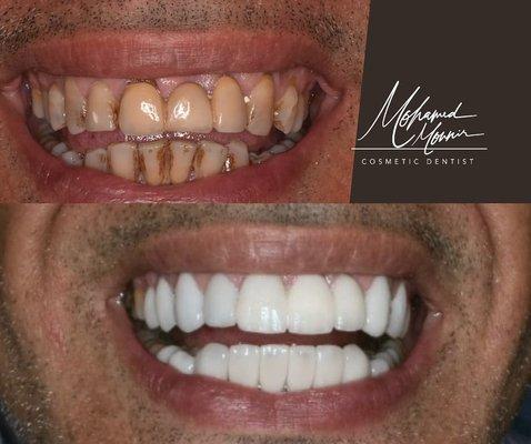 Teeth veneers