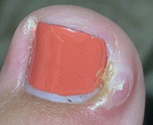 In this picture is what my toe looks like from the pedicure